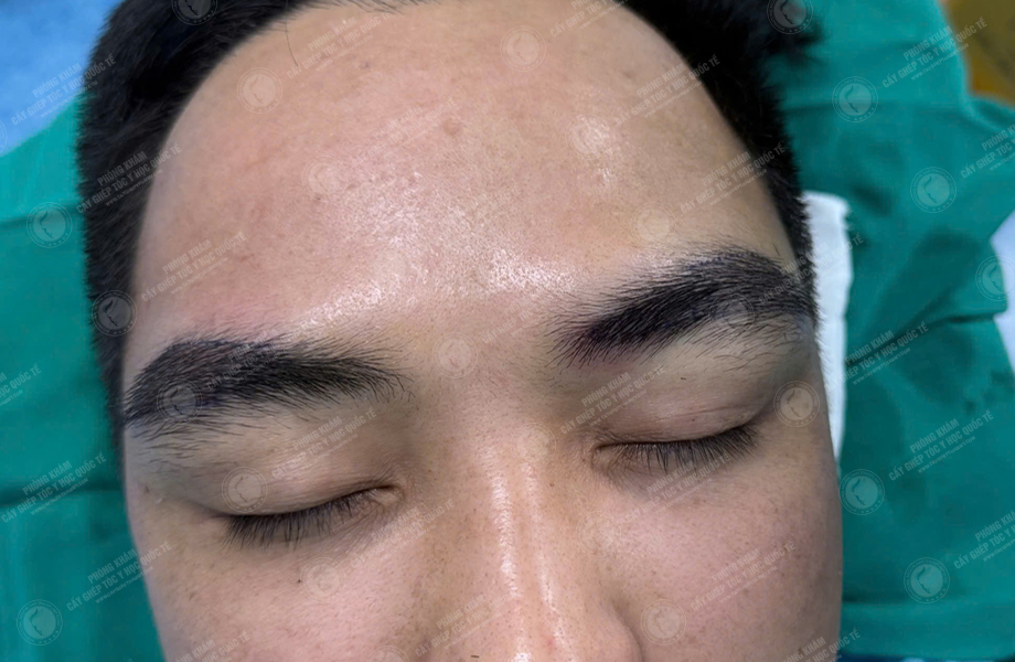 Lý Văn Cường - Cấy lông mày 4