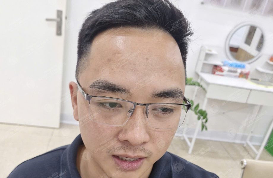 Lý Văn Cường - Cấy lông mày 5