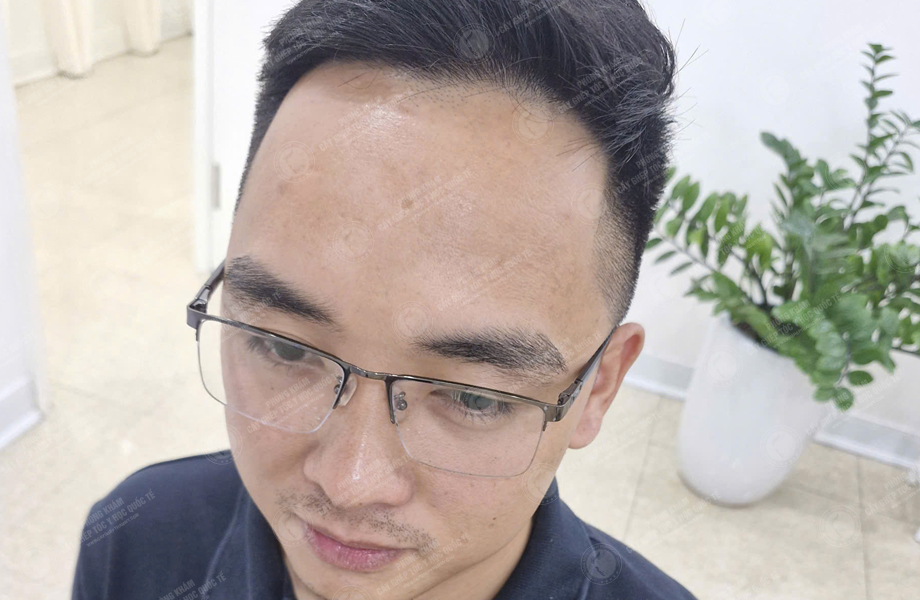 Lý Văn Cường - Cấy lông mày 6