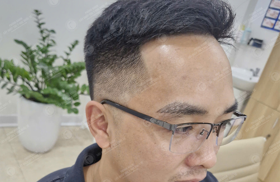 Lý Văn Cường - Cấy lông mày 7