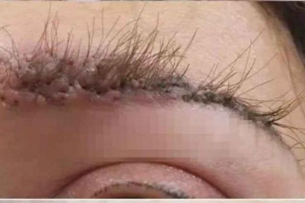 Biến chứng khi cấy chân mày: Hệ lụy khôn lường từ những ca cấy kém an toàn