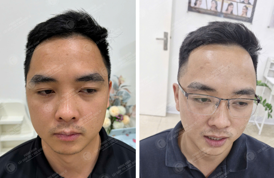  Lý Văn Cường - Cấy lông mày 1