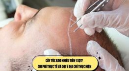 Cấy tóc bao nhiêu tiền 1 sợi? Chi phí thực tế và gợi ý địa chỉ thực hiện