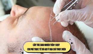 Cấy tóc bao nhiêu tiền 1 sợi? Chi phí thực tế và gợi ý địa chỉ thực hiện