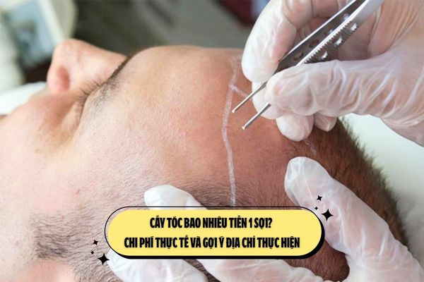 Cấy tóc bao nhiêu tiền 1 sợi? Chi phí thực tế và gợi ý địa chỉ thực hiện