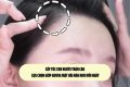 Cấy tóc cho người trán cao: Lựa chọn giúp gương mặt hài hòa hơn mỗi ngày