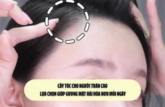 Cấy tóc cho người trán cao: Lựa chọn giúp gương mặt hài hòa hơn mỗi ngày