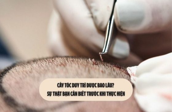 Cấy tóc duy trì được bao lâu? Sự thật bạn cần biết trước khi thực hiện