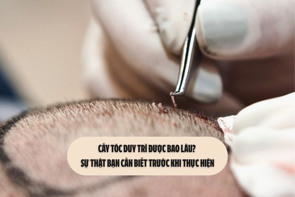 Cấy tóc duy trì được bao lâu? Sự thật bạn cần biết trước khi thực hiện