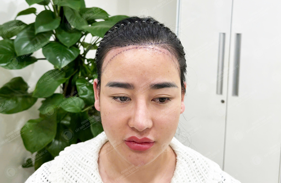 Ngô Thanh Lan - Cấy tóc đường chữ M 2