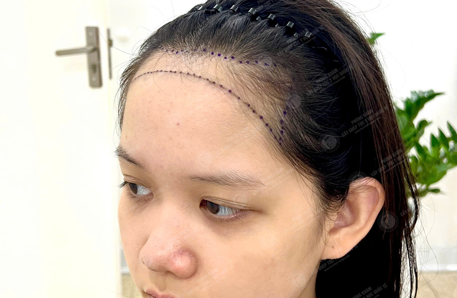 Nguyễn Hồng Ngọc - Cấy tóc đường chữ M 2