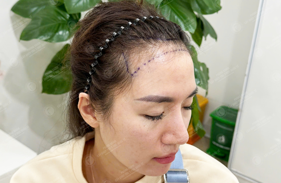 Ngô Thùy Dung - Cấy tóc đường chữ M 2
