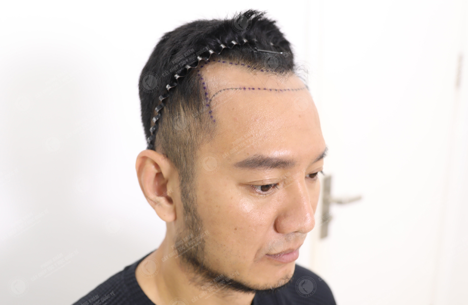 Youtuber Hùng Lâm - Cấy tóc đường chữ M 2
