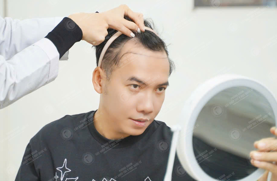 Ca sĩ Phạm Trưởng - Cấy tóc đường chữ M 2