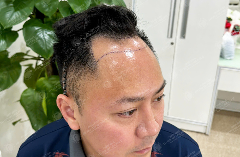Phùng Minh Sơn - Cấy tóc đường chữ M 2