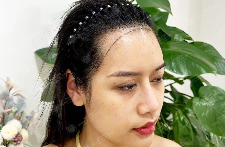 Nguyễn Quỳnh Ly - Cấy tóc đường chữ M 2