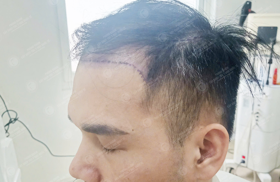 Trần Thanh Hưng - Cấy tóc đường chữ M 2