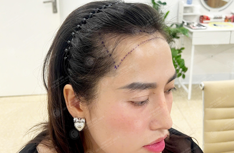Đinh Thị Hà - Cấy tóc đường chữ M 2