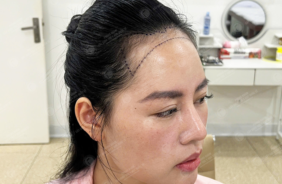 Ngô Thùy Linh - Cấy tóc đường chữ M 2