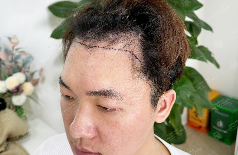 Chih Cheng - Cấy tóc đường chữ M 2