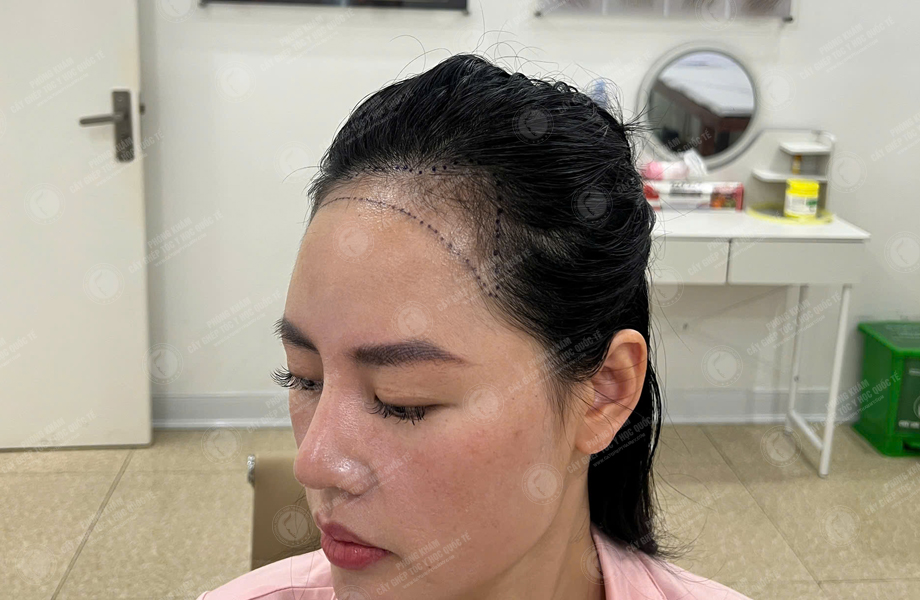 Lê Lan Anh - Cấy tóc đường chữ M 2