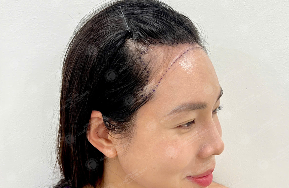 Nguyễn Thị Hồng - Cấy tóc đường chữ M 2