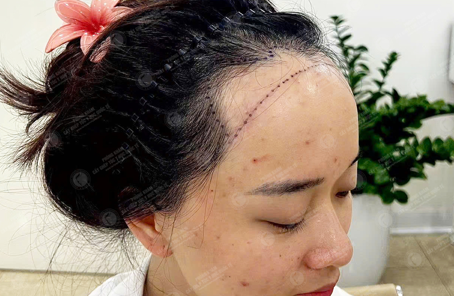 Nguyễn Hồng Ánh - Cấy tóc đường chữ M 2