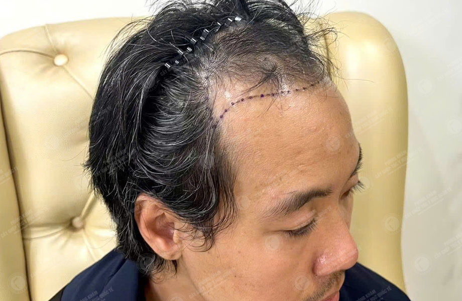 Lý Hùng Mạnh - Cấy tóc đường chữ M 2