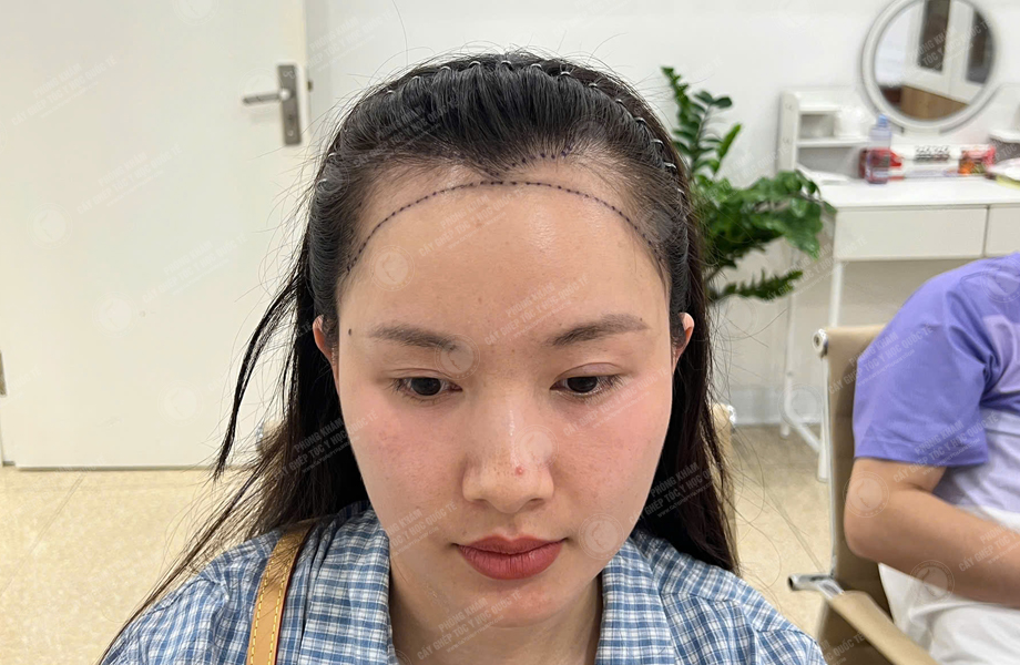 Trần Thị Mận - Cấy tóc đường chữ M 2