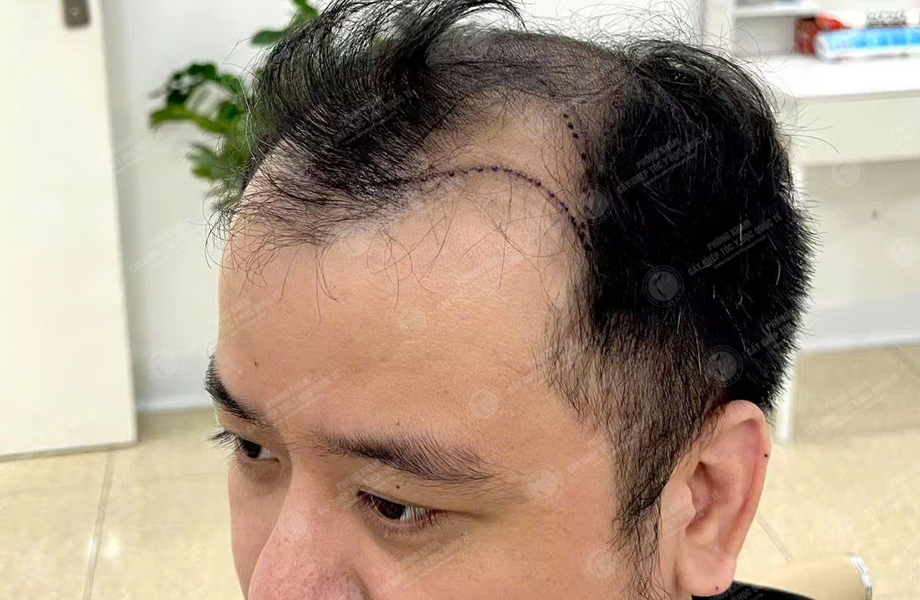Đỗ Tùng Sơn - Cấy tóc đường chữ M 2