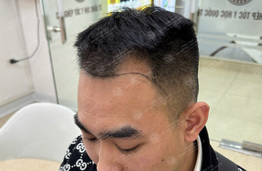 Nguyễn Hoàng Trung - Cấy tóc đường chữ M 2