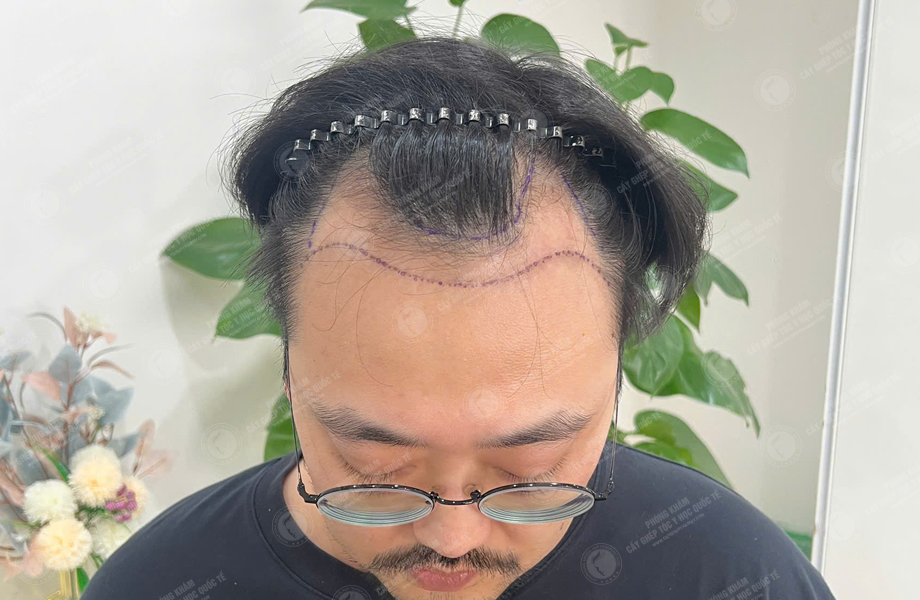 Phạm Tuấn Hùng - Cấy tóc đường chữ M 2