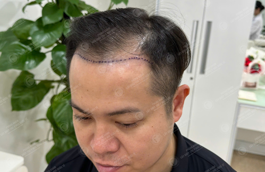 Trần Ngọc Thanh - Cấy tóc đường chữ M 2