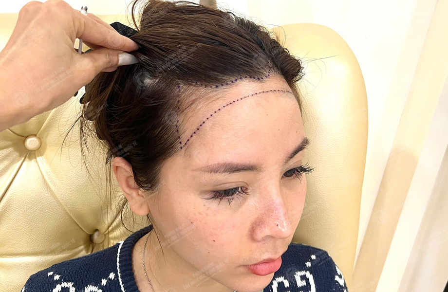 Mai Thị Hoa - Cấy tóc đường chữ M 2