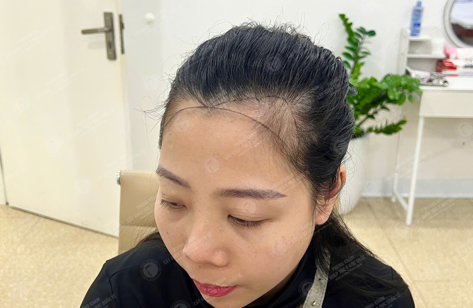 Lê Thị Lý - Cấy tóc đường chữ M 2