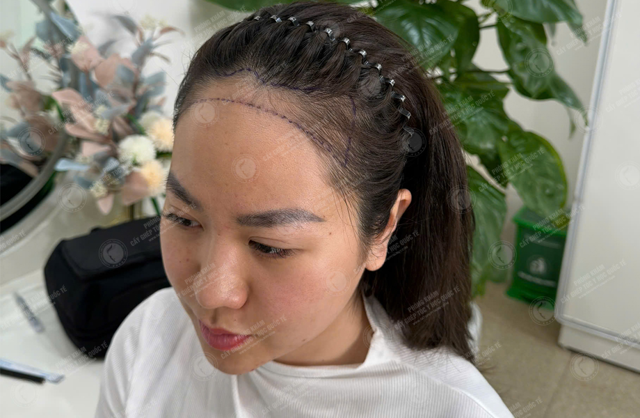 Trần Hồng Nhung - Cấy tóc đường chữ M 2