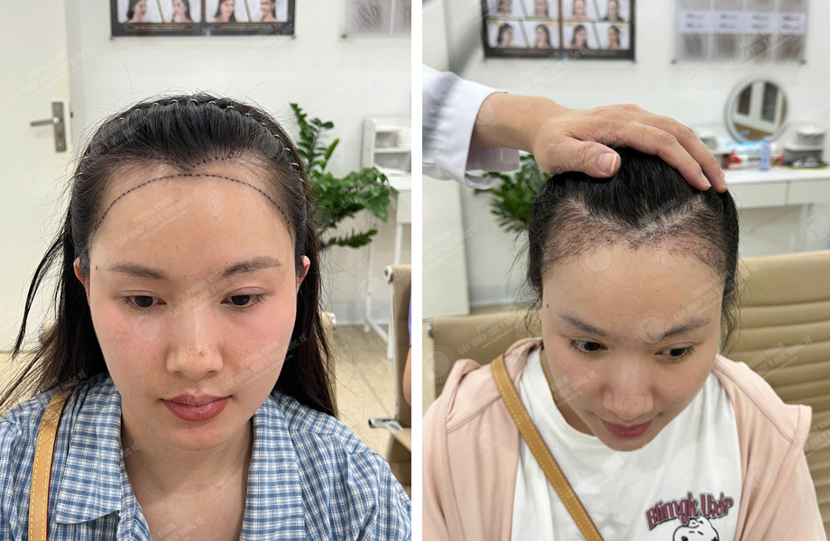  Trần Thị Mận - Cấy tóc tự thân 1