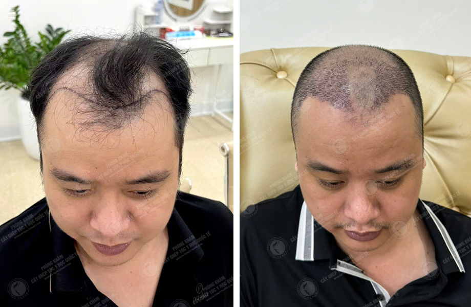  Đỗ Tùng Sơn - Cấy tóc tự thân 1