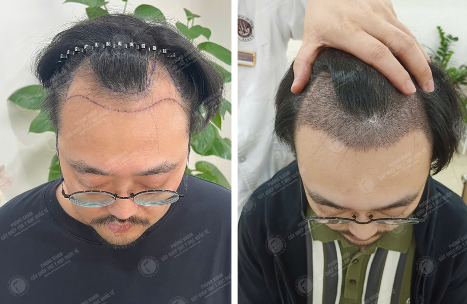  Phạm Tuấn Hùng - Cấy tóc đường chữ M 1