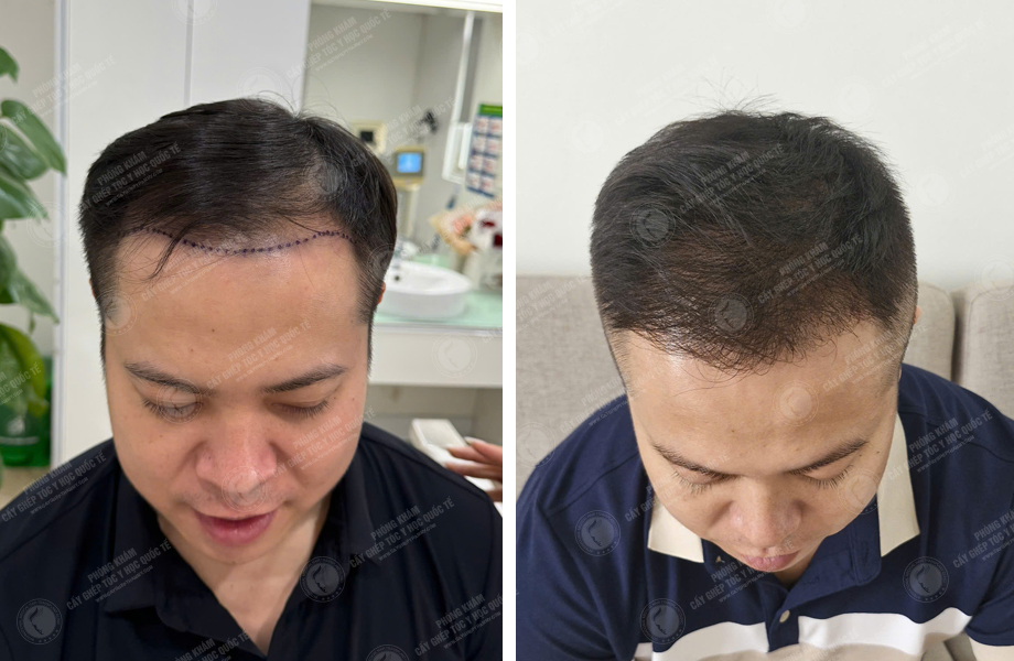  Trần Ngọc Thanh - Cấy tóc tự thân 1