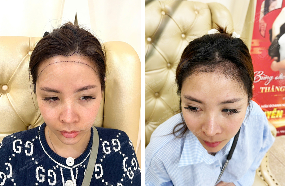  Mai Thị Hoa - Cấy tóc đường chữ M 1