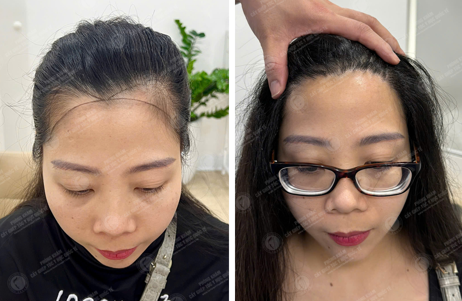  Lê Thị Lý - Cấy tóc đường chữ M 1