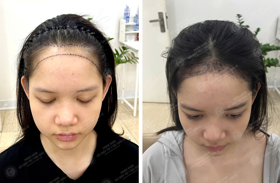  Nguyễn Hồng Ngọc - Cấy tóc đường chữ M 1