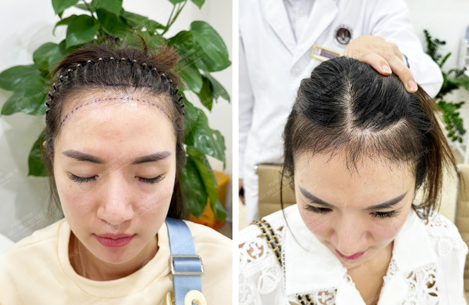  Ngô Thùy Dung - Cấy tóc đường chữ M 1