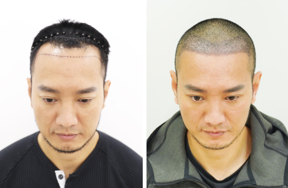  Youtuber Hùng Lâm - Cấy tóc đường chữ M 1