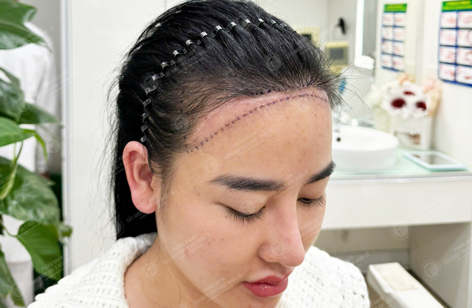 Ngô Thanh Lan - Cấy tóc đường chữ M 3