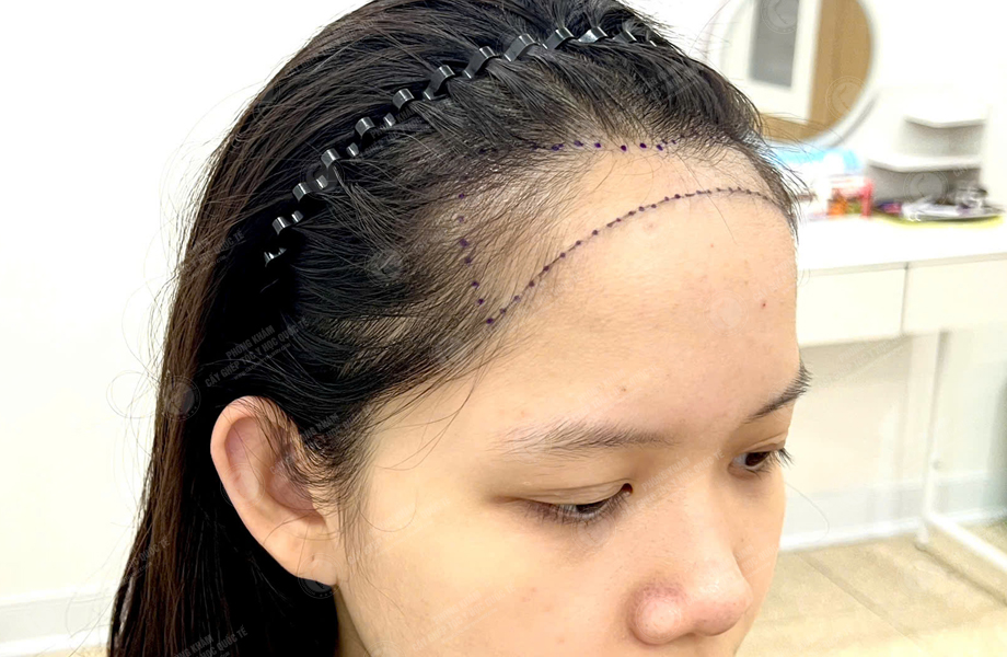 Nguyễn Hồng Ngọc - Cấy tóc đường chữ M 3