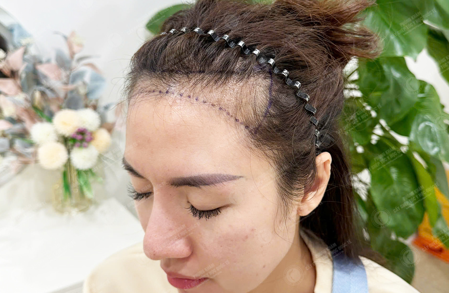 Ngô Thùy Dung - Cấy tóc đường chữ M 3