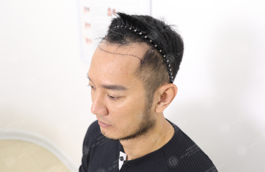 Youtuber Hùng Lâm - Cấy tóc đường chữ M 3