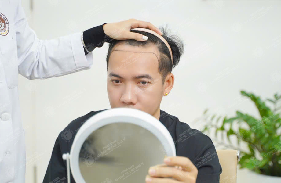 Ca sĩ Phạm Trưởng - Cấy tóc đường chữ M 3